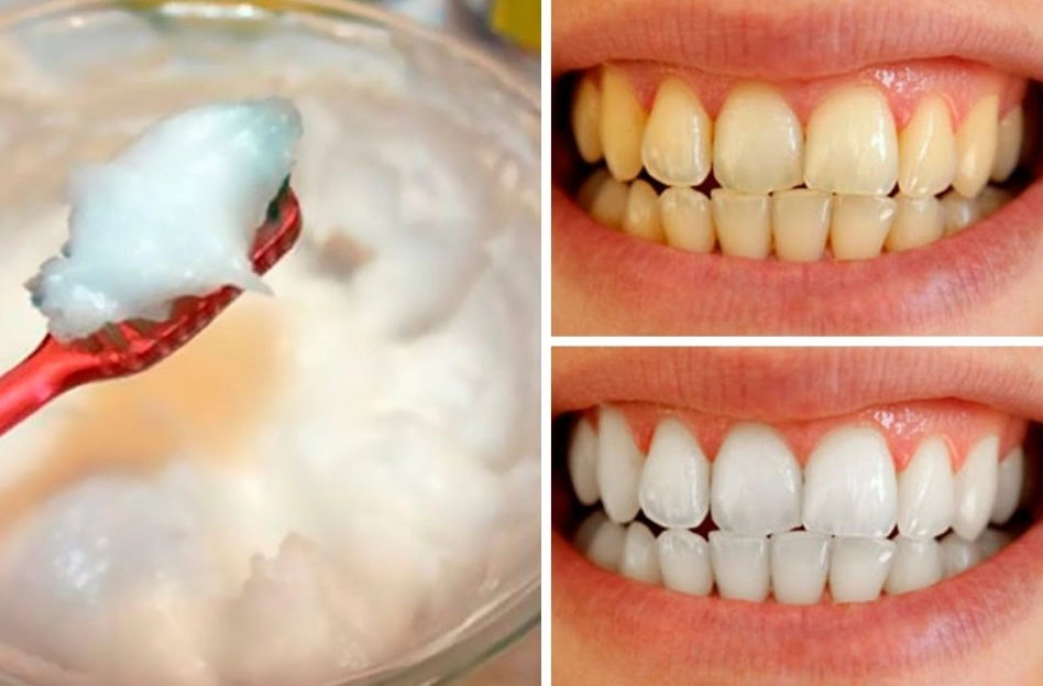 3 minute teeth whitening 3 minute teeth whitening