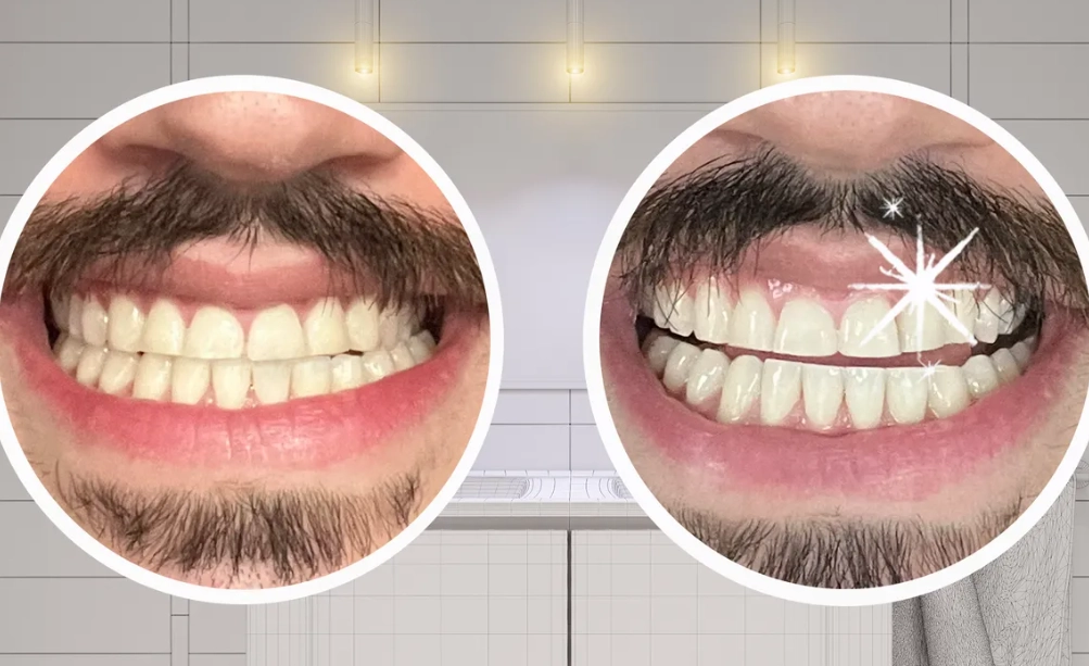 teeth whitening strips teeth whitening strips