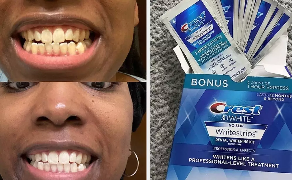 crest white strips results crest white strips results