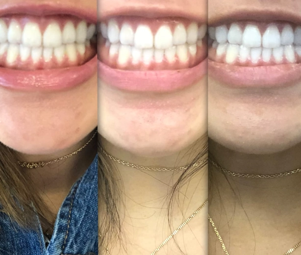 teeth whitening strips teeth whitening strips
