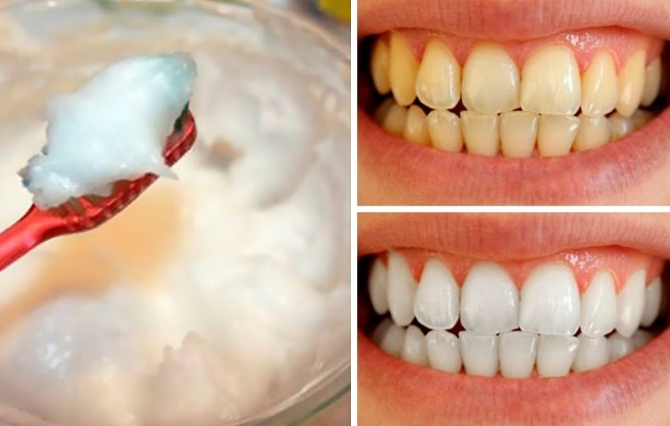 home remedies for white teeth home remedies for white teeth