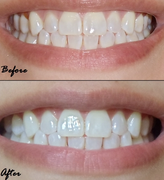 maintain white teeth after strips maintain white teeth after strips