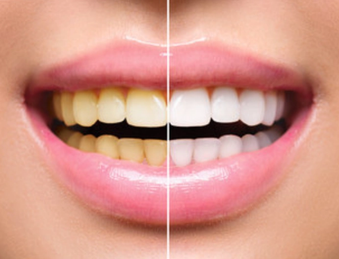 teeth whitening at home teeth whitening at home