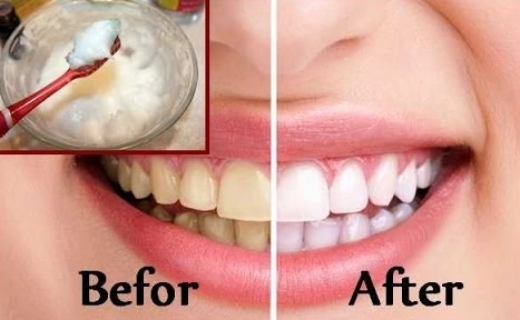 Teeth whitening at home in 2 minutes