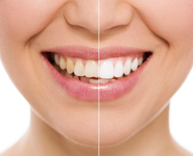 maintain white teeth after strips maintain white teeth after strips
