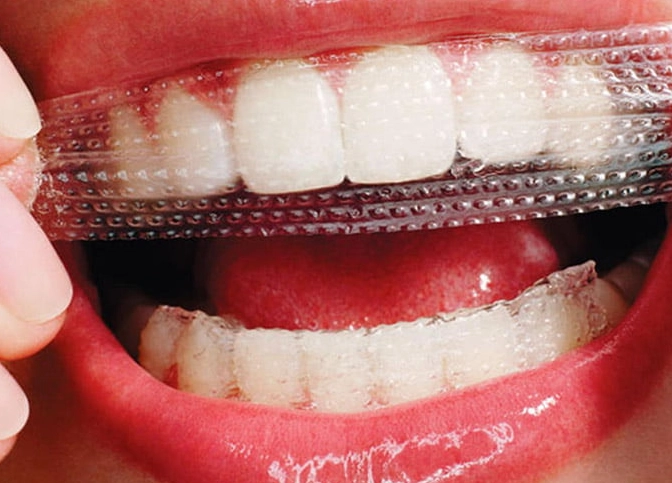 how long does teeth whitening last how long does teeth whitening last